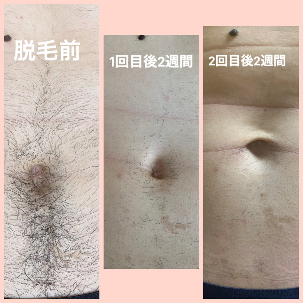 脱毛