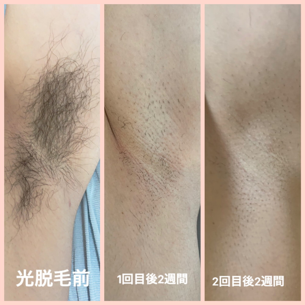 脱毛
